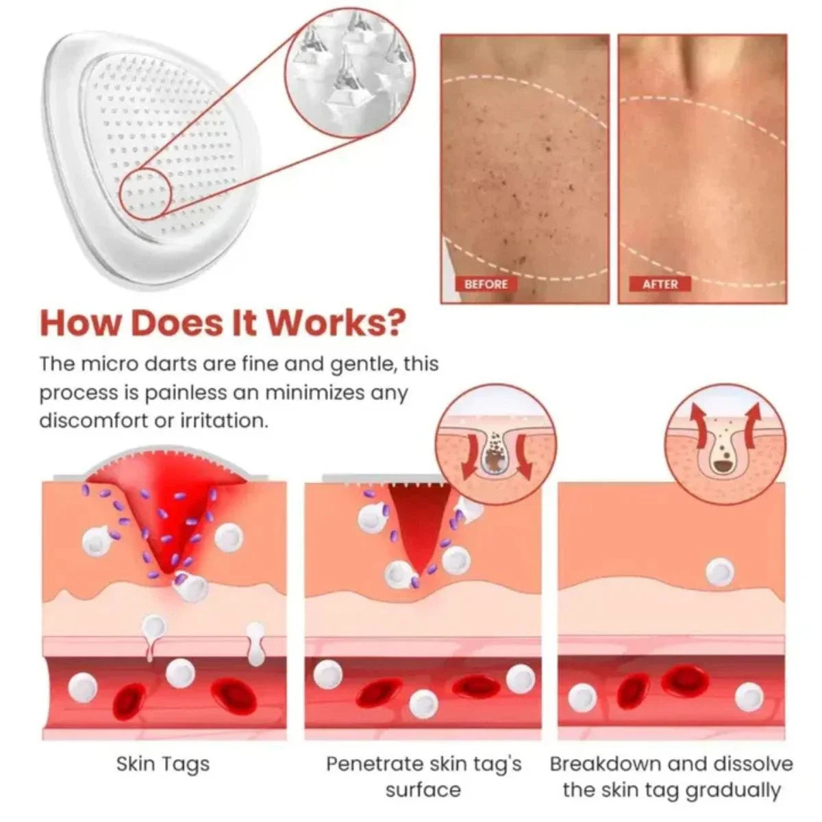 DermaSmooth Skin Tag Remover Patch Rida's Collection