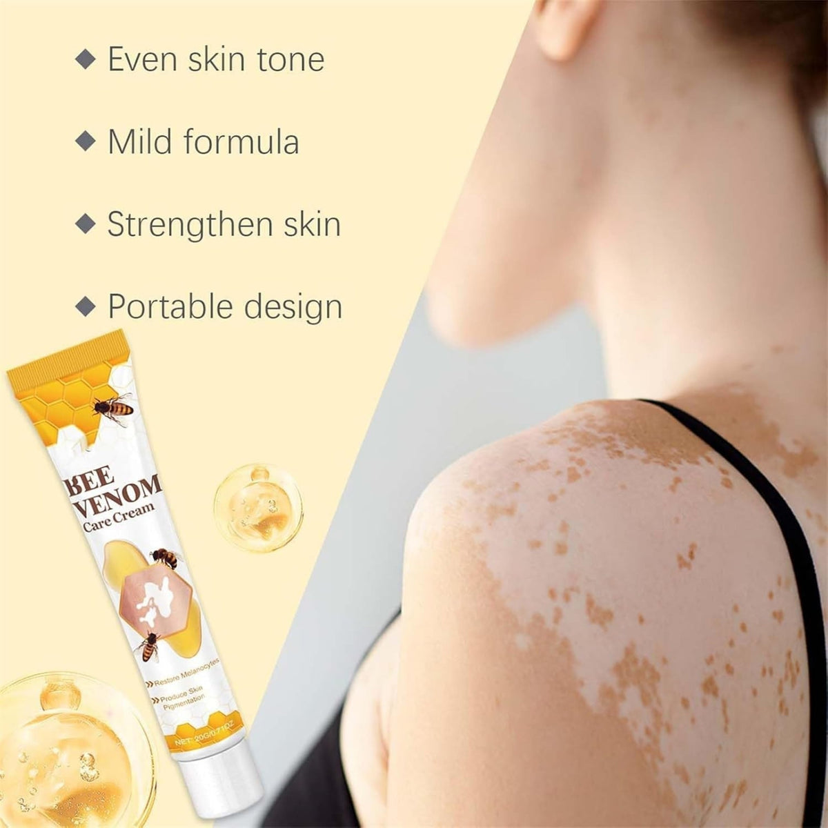 Vitigo Bee Venom Treatment Cream YMDS