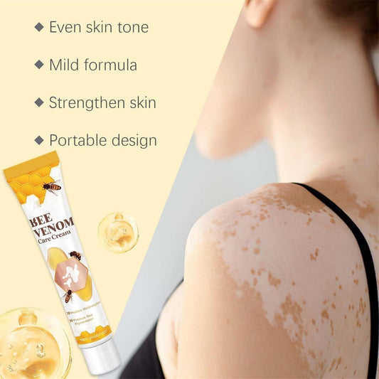 Vitigo Bee Venom Treatment Cream YMDS