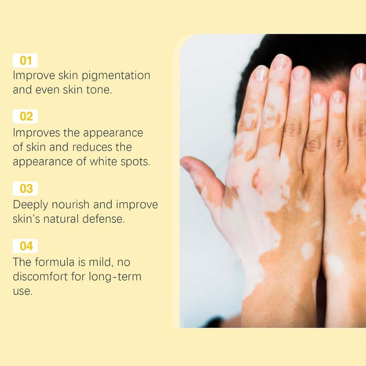 Vitigo Bee Venom Treatment Cream YMDS