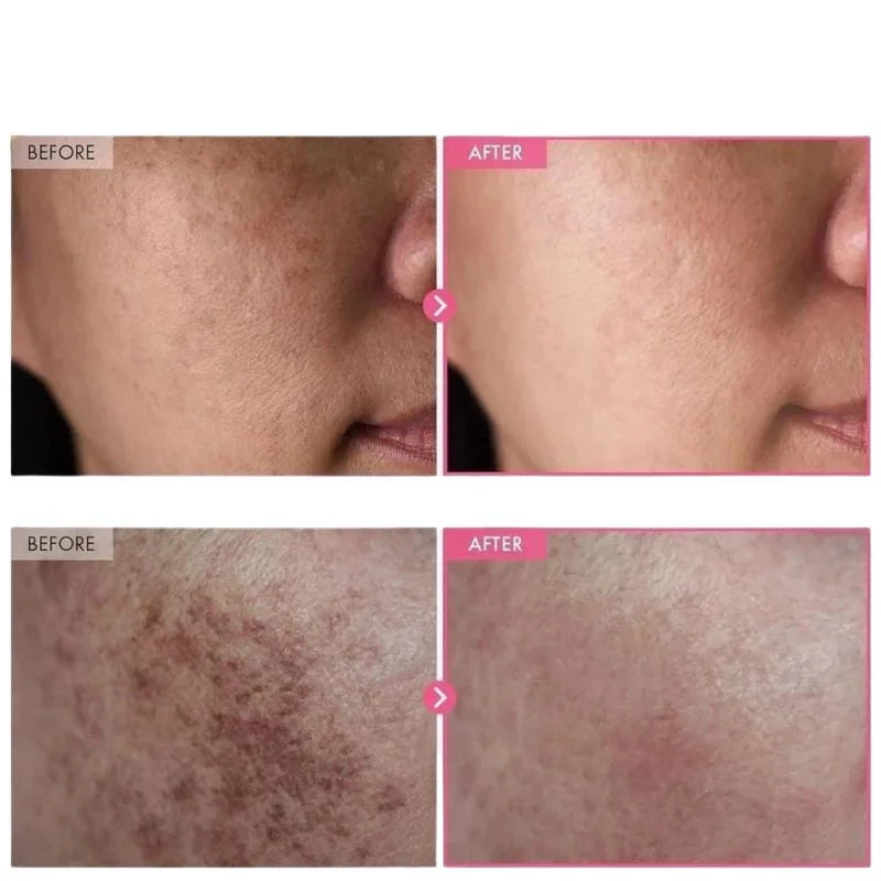 Arbutin 7% + Tranexamic Acid 4% Cream YMDS