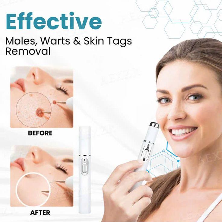 Mole And Wart Removal Pen Non Invasive Mole And Wart Removal ARDS
