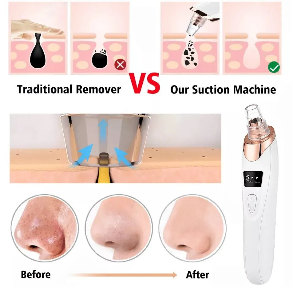 5-in-1 Blackhead Remover Machine – Rechargeable Face Vacuum with 5 Heads HHC
