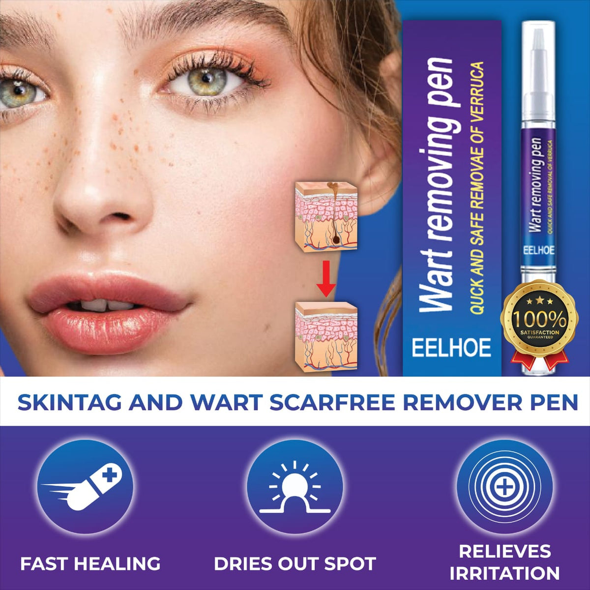 Wart Remover Gel Pen – Powerful Wart Removal HHC