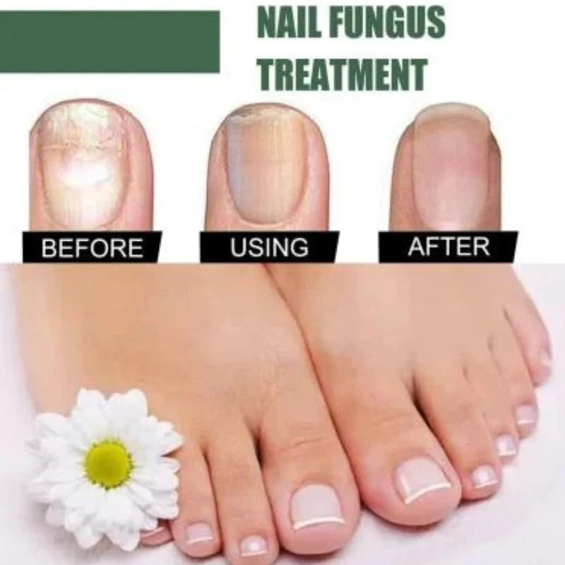 Fast Nail Fungus Treatment Serum YMDS