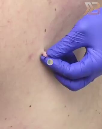 Wart Remover Gel Pen – Powerful Wart Removal