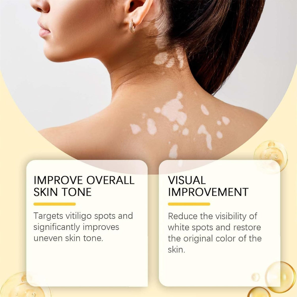 Vitigo Bee Venom Treatment Cream YMDS