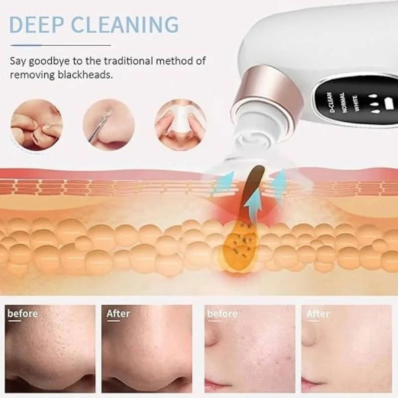 Electric Super Micro Bubble Beauty Blackhead Remover YMDS