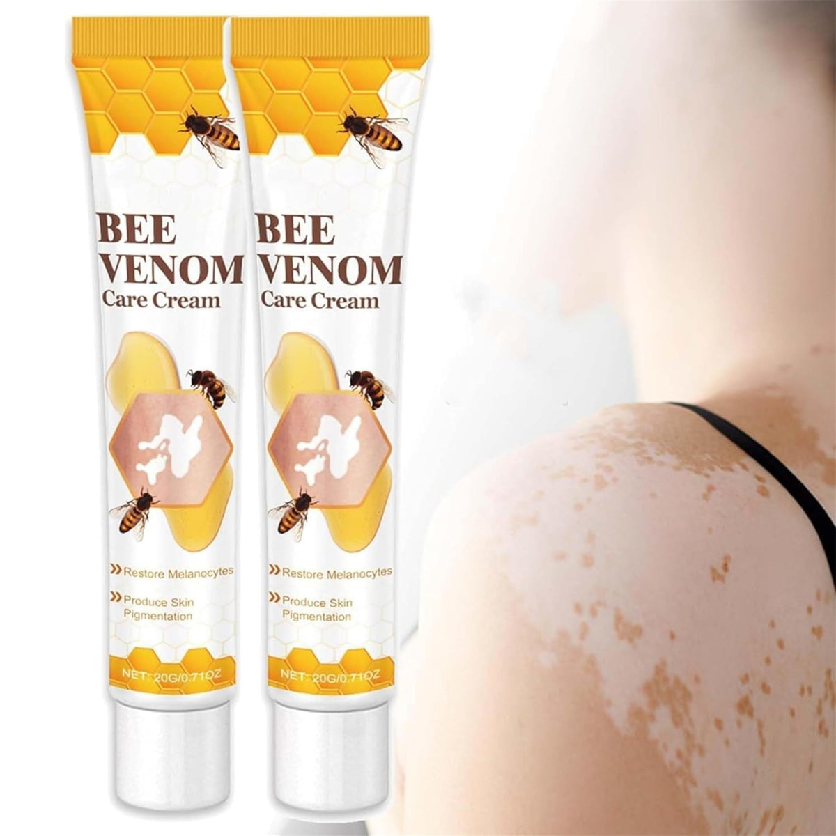 Vitigo Bee Venom Treatment Cream YMDS