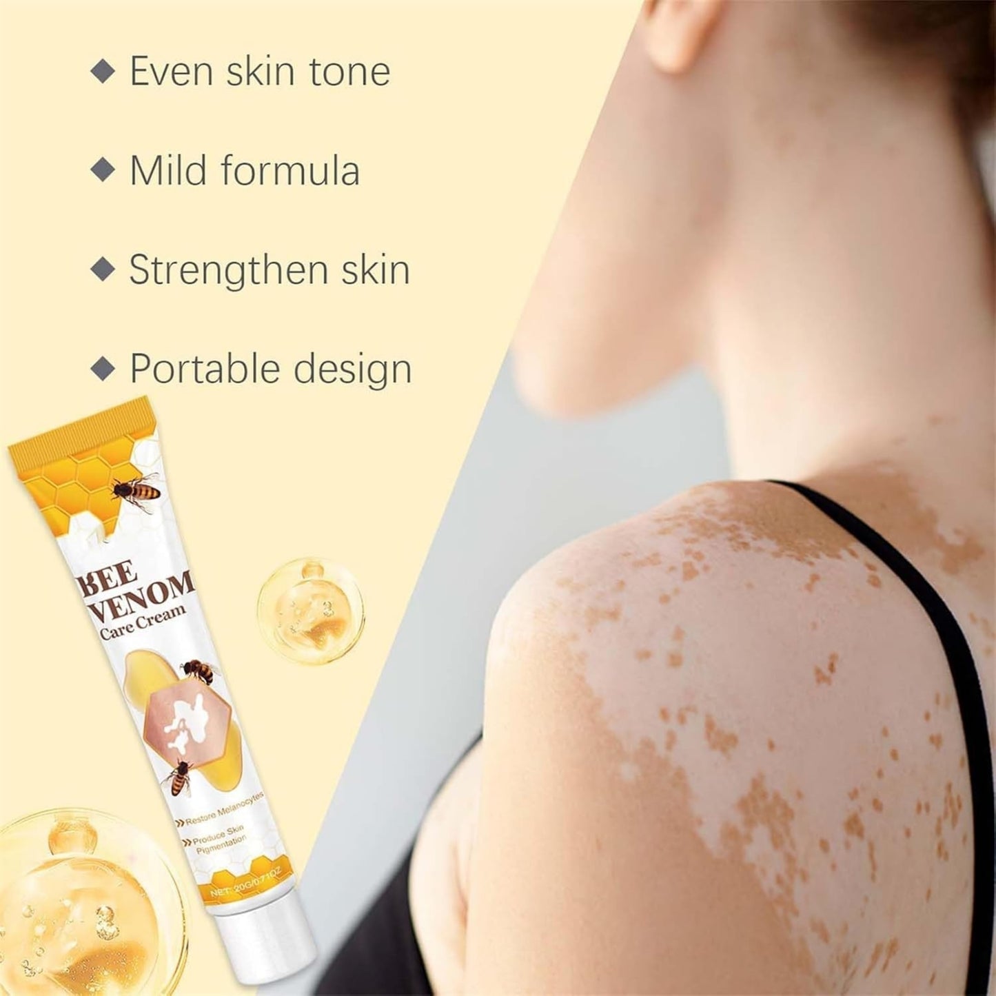 Vitigo Bee Venom Treatment Cream