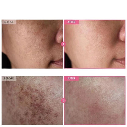 Arbutin 7% + Tranexamic Acid 4% Cream YMDS