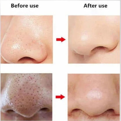 Rechargeable Blackhead Remover Vacuum Cleaner YMDS