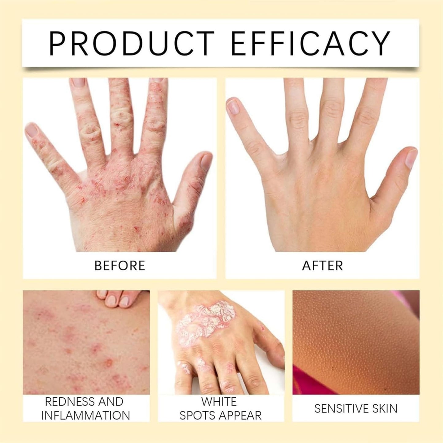 Vitigo Bee Venom Treatment Cream