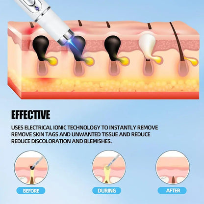 Mole And Wart Removal Pen Non Invasive Mole And Wart Removal ARDS