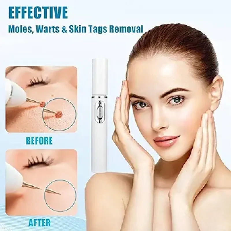 Mole And Wart Removal Pen Non Invasive Mole And Wart Removal ARDS