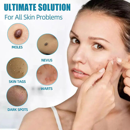 Mole And Wart Removal Pen Non Invasive Mole And Wart Removal ARDS