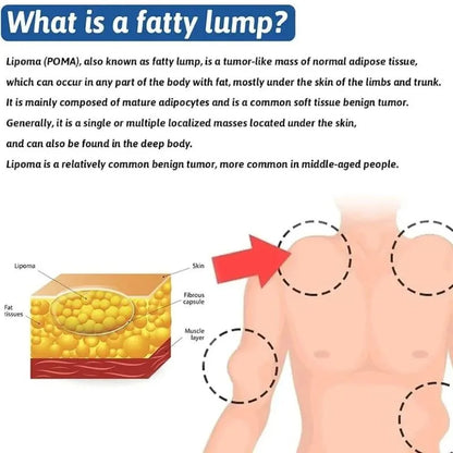 Lipoma Removal Cream