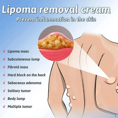Lipoma Removal Cream